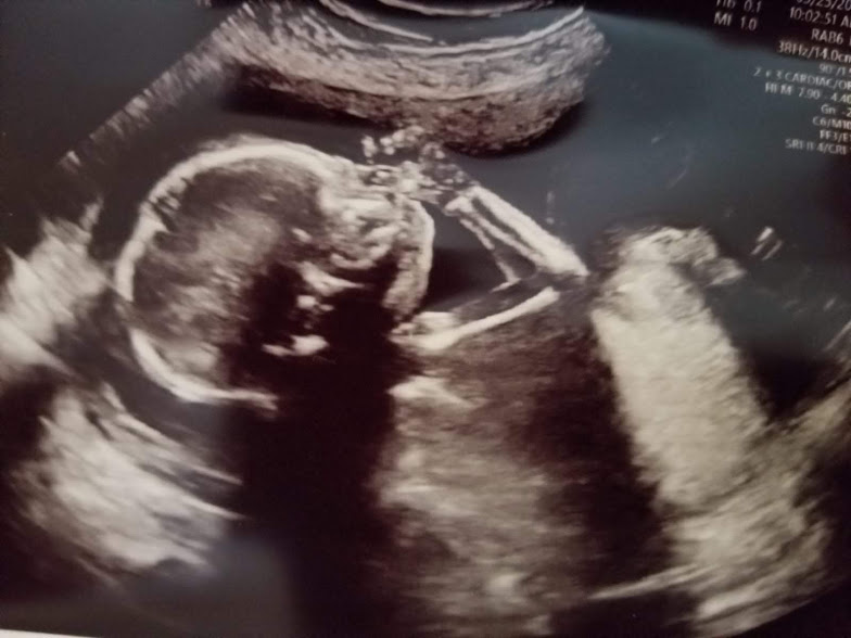 baby 2 ultrasound